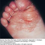 Click image for larger version

Name:	ped foot fungus (426 x 422).jpg
Views:	67
Size:	49.7 KB
ID:	985001