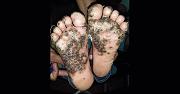 Click image for larger version

Name:	tungiasis (540 x 282).jpg
Views:	149
Size:	23.2 KB
ID:	985009